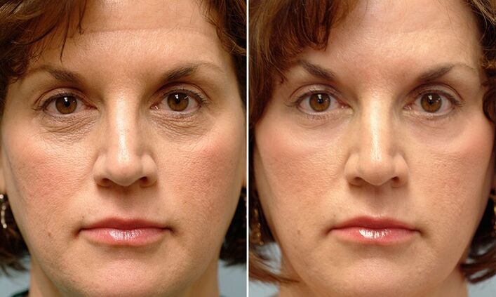 πρόσωπο πριν και μετά την κλασματική αναζωογόνηση με λέιζερ
